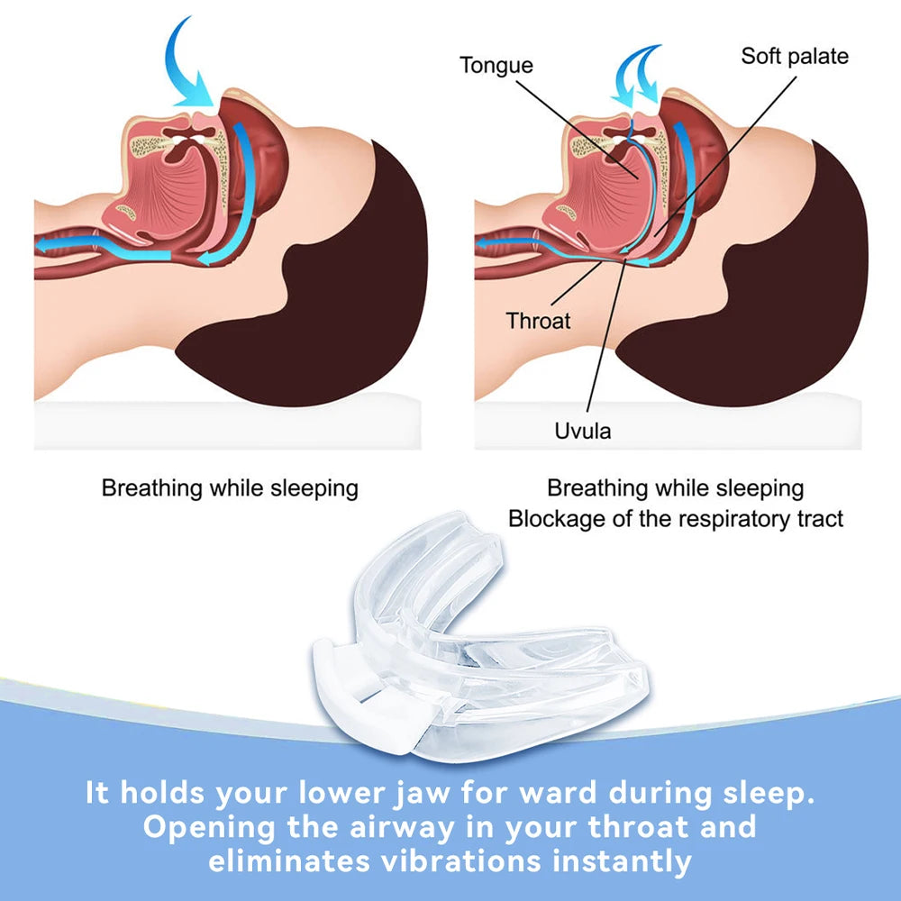 Aura SleepGuard Anti-Snoring Mouthpiece - Image [N]
